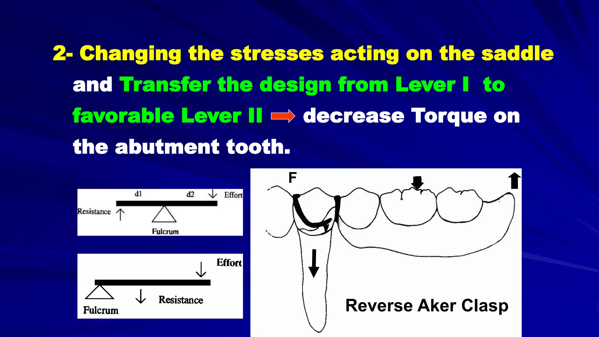 5- Basic principles for designing the removable partial denture (class i partial denture design)
