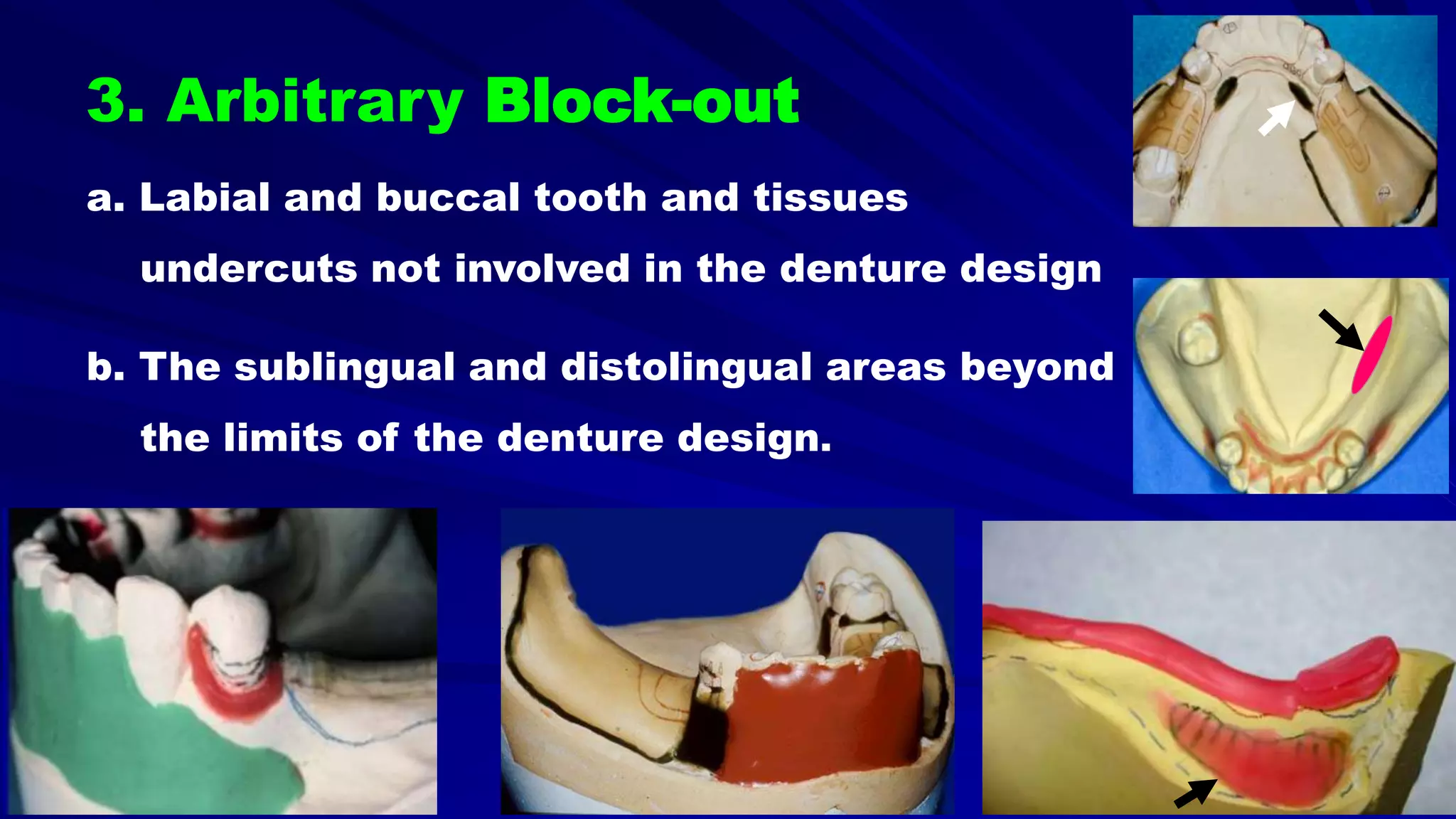 5- Basic principles for designing the removable partial denture (class i partial denture design)
