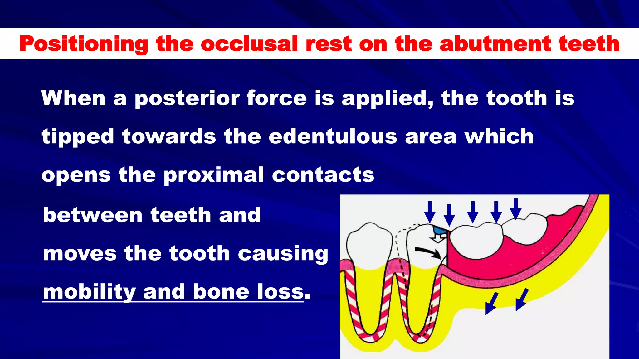 5- Basic principles for designing the removable partial denture (class i partial denture design)