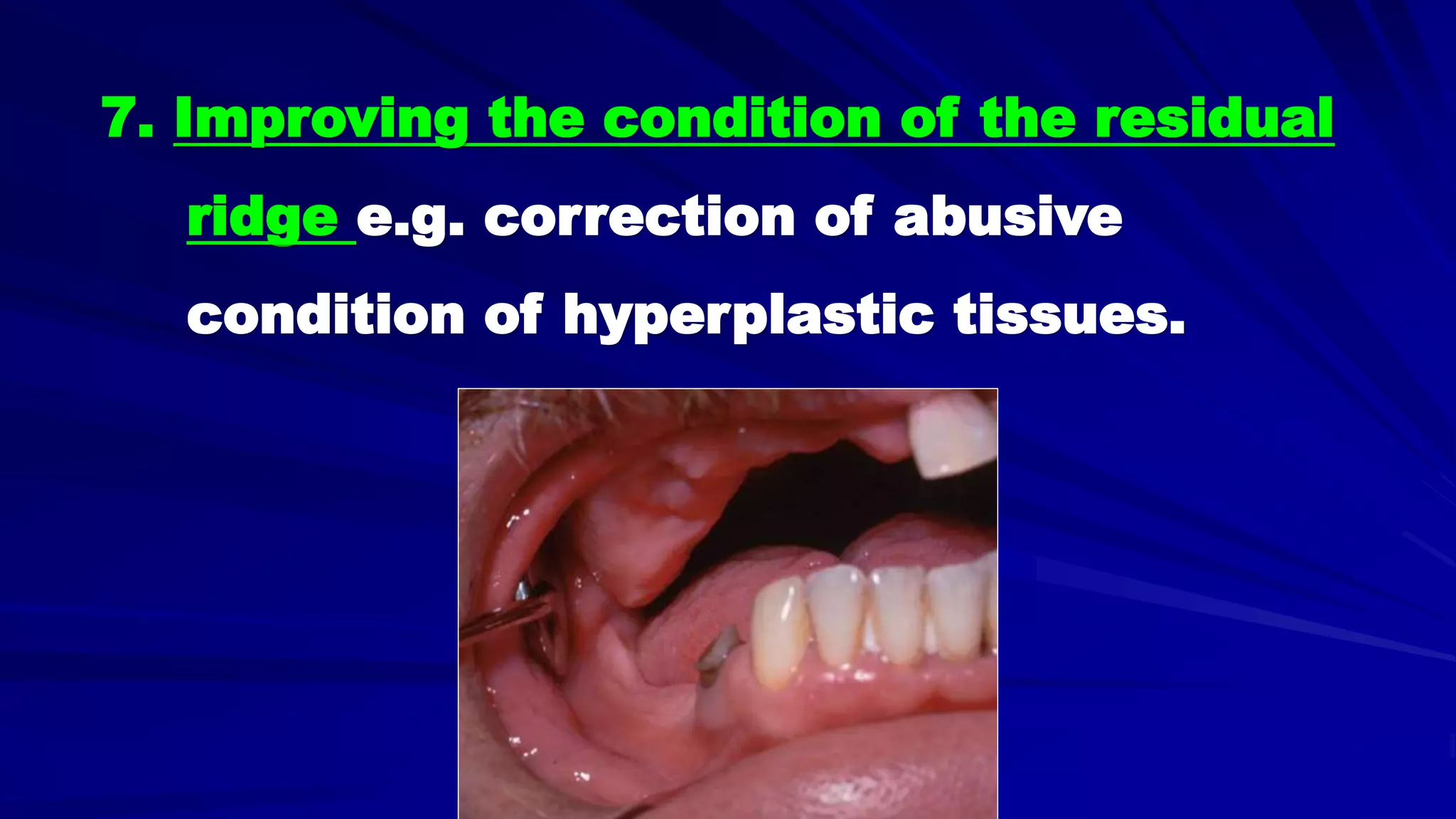5- Basic principles for designing the removable partial denture (class i partial denture design)
