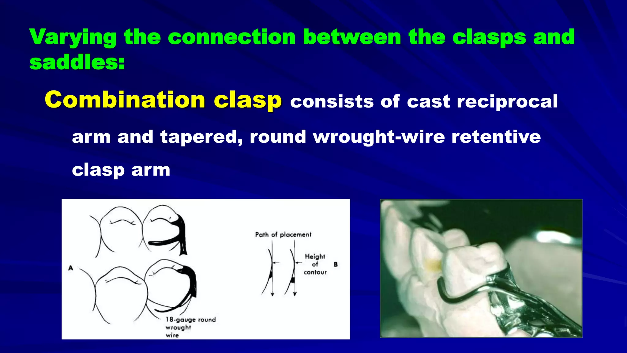 5- Basic principles for designing the removable partial denture (class i partial denture design)