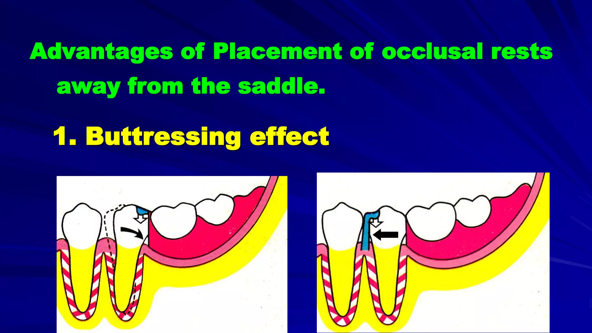 5- Basic principles for designing the removable partial denture (class i partial denture design)