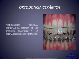 ORTODONCIA CERÁMICATEÓRICAMENTE DEBERÍAN COMBINAR LA ESTÉTICA DE LOS BRACKETS PLÁSTICOS Y LA CONFIABILIDAD DE LOS METÁLICOS.FUNDAMENTOS Y PRINCIPIOS DE LA ORTOPEDIA DENTOMAXILOFACIAL 617, 643: 0-36