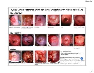 5. cáncer de cuello uterino