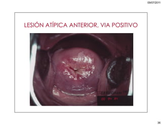 5. cáncer de cuello uterino