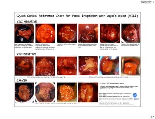 5. cáncer de cuello uterino