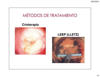 5. cáncer de cuello uterino