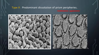 Type II : Predominant dissolution of prism peripheries.
41
Cobblestone appearance
 