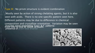 Type III : No prism structure is evident/combination
Mostly seen by action of strong chelating agents, but it is also
seen with acids. There is no one specific pattern seen here.
Different patterns may be due to difference in chemical
composition and crystalline orientation. Variation may be seen
from site to site or tooth to tooth.
42
Includes areas resembling Type I & II patterns-
presence of prism less enamel
 