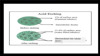 85
(Demineralized inter tubular
dentin )
 