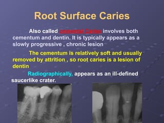 5-Dental Caries radiology in dentistry . | PPTX
