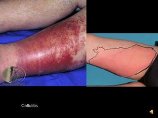 Cellulitis
 