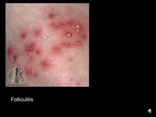 Folliculitis
 