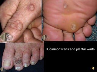 Common warts and plantar warts
 