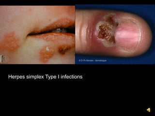 Herpes simplex Type I infections
 