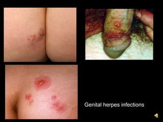 Genital herpes infections
 