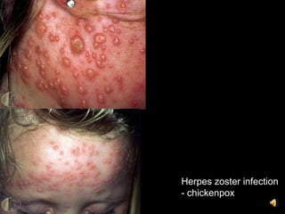 Herpes zoster infection
- chickenpox
 