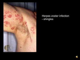 Herpes zoster infection
- shingles
 