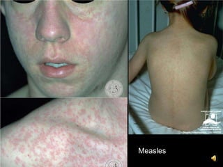Measles
 