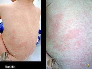 Rubella
 