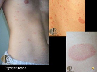 Pityriasis rosea
 