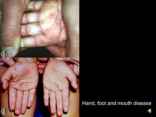 Hand, foot and mouth disease
 