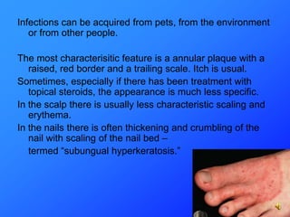 Infections can be acquired from pets, from the environment
   or from other people.

The most characterisitic feature is a annular plaque with a
   raised, red border and a trailing scale. Itch is usual.
Sometimes, especially if there has been treatment with
   topical steroids, the appearance is much less specific.
In the scalp there is usually less characteristic scaling and
   erythema.
In the nails there is often thickening and crumbling of the
   nail with scaling of the nail bed –
   termed “subungual hyperkeratosis.”
 
