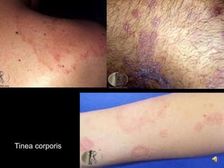 Tinea corporis
 