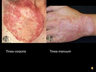 Tinea corporis   Tinea manuum
 