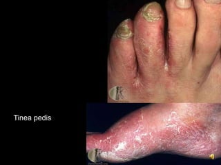 Tinea pedis
 