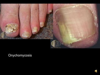 Onychomycosis
 