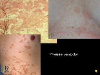 Pityriasis versicolor
 