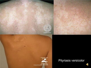 Pityriasis versicolor
 