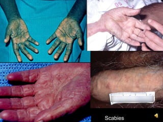 Scabies
 