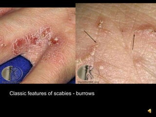 Classic features of scabies - burrows
 