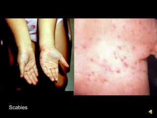 Scabies
 