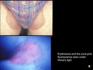 Erythrasma and the coral pink
fluorescence seen under
Wood’s light
 