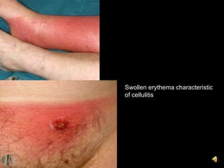 Swollen erythema characteristic
of cellulitis
 