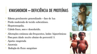 KWASHIOKOR–DEFICIÊNCIA DE PROTEÍNAS
• Edema geralmente generalizado – face de lua
• Perda moderada de tecido subcutâneo.
• Hepatomegalia.
• Cabelo fraco, seco e descolorido.
• Alterações cutâneas são frequentes, lesões hipocrômicas
• Peso para idade muito abaixo do percentil 3.
• Apatia exagerada
• Anorexia
• Redução do fluxo sanguíneo
 