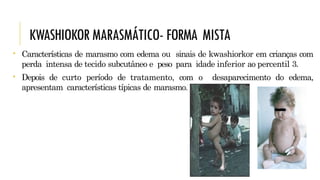 KWASHIOKORMARASMÁTICO- FORMA MISTA
• Características de marasmo com edema ou sinais de kwashiorkor em crianças com
perda intensa de tecido subcutâneo e peso para idade inferior ao percentil 3.
• Depois de curto período de tratamento, com o desaparecimento do edema,
apresentam características típicas de marasmo.
 