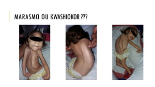MARASMO OU KWASHIOKOR???
 