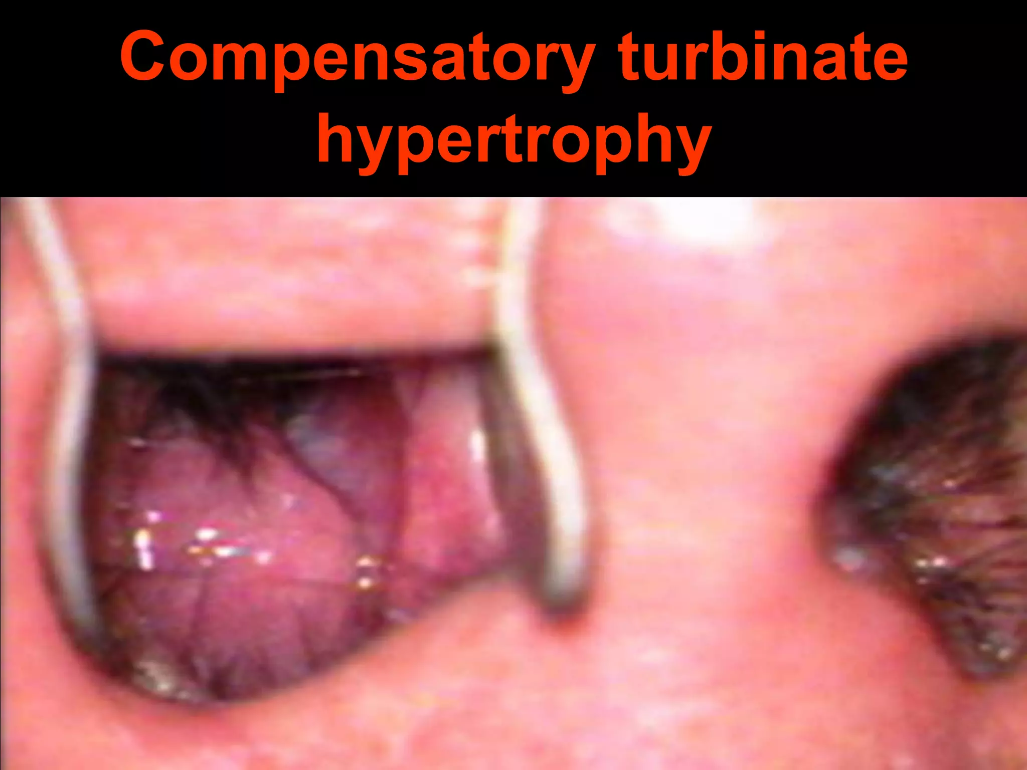Compensatory turbinate
hypertrophy

 