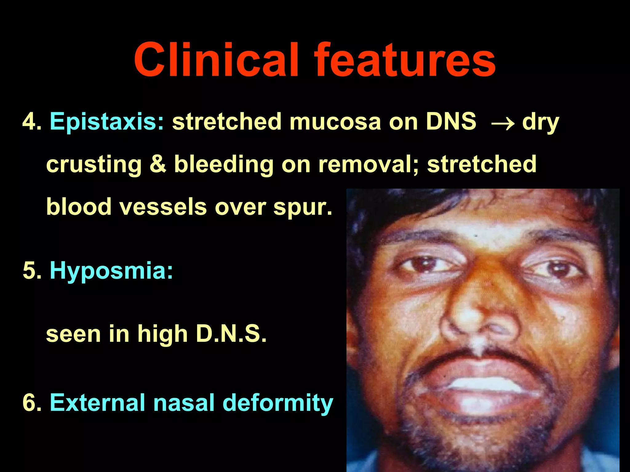 Clinical features
4. Epistaxis: stretched mucosa on DNS  dry

crusting & bleeding on removal; stretched
blood vessels over spur.
5. Hyposmia:
seen in high D.N.S.

6. External nasal deformity

 