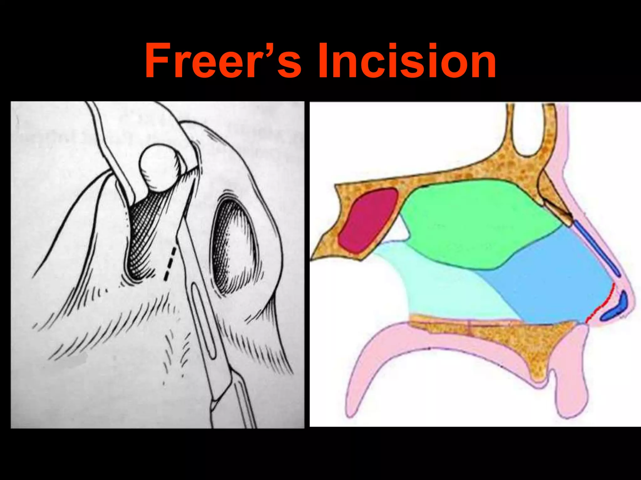 Freer’s Incision

 