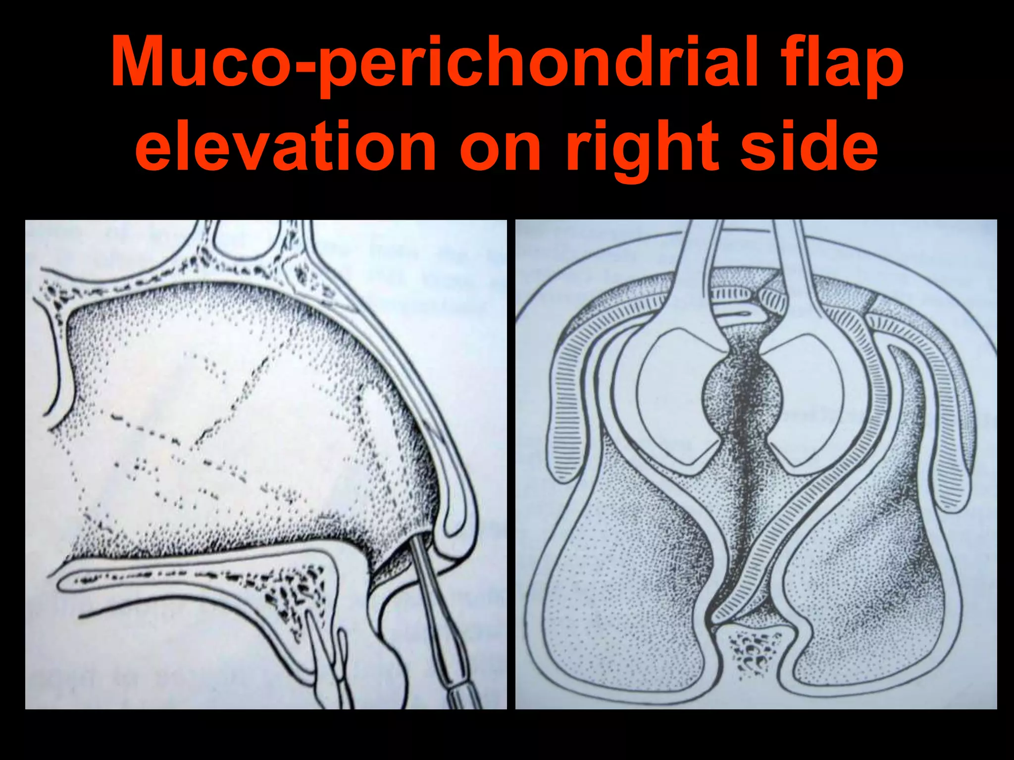 Muco-perichondrial flap
elevation on right side

 
