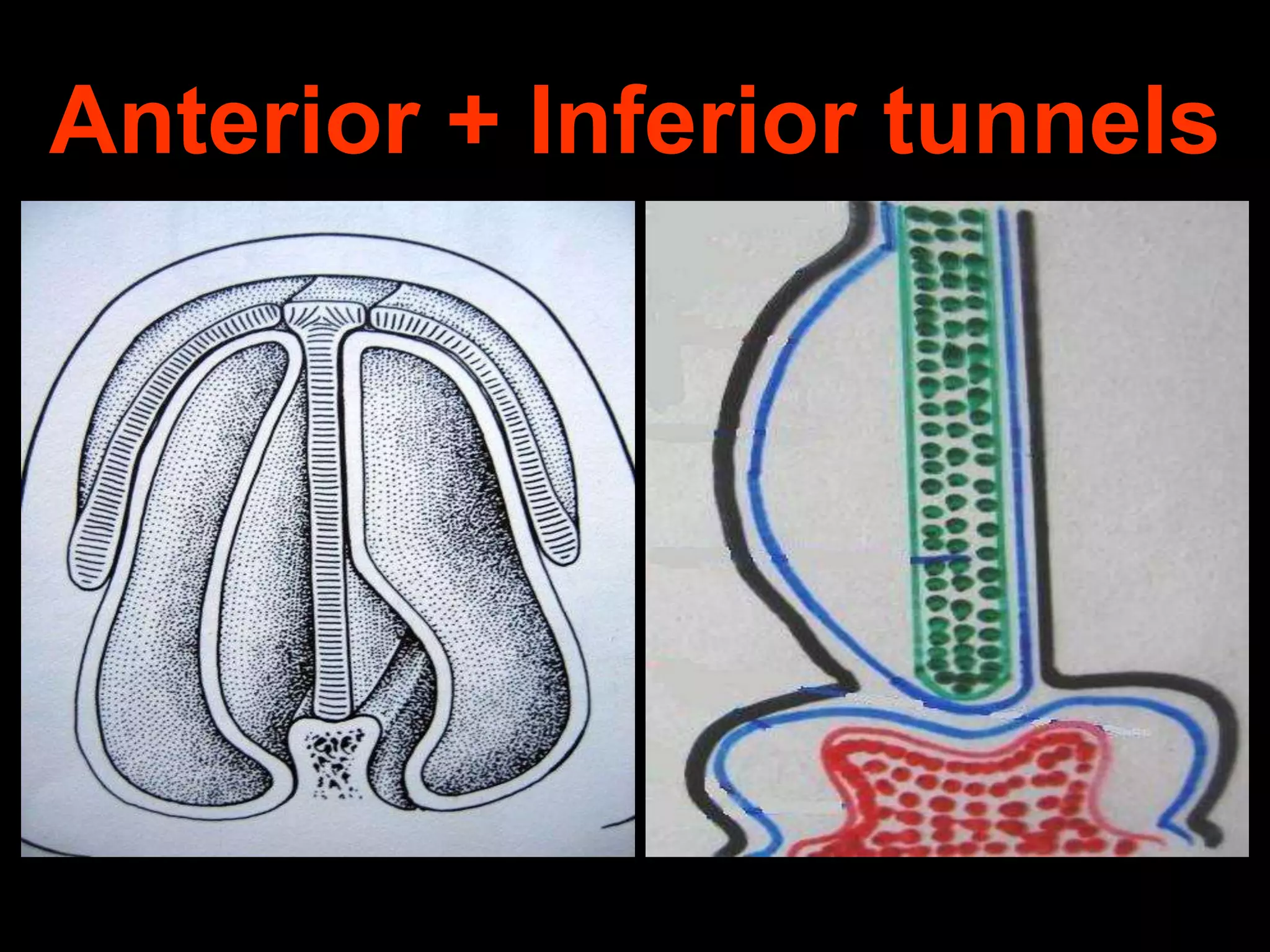 Anterior + Inferior tunnels

 