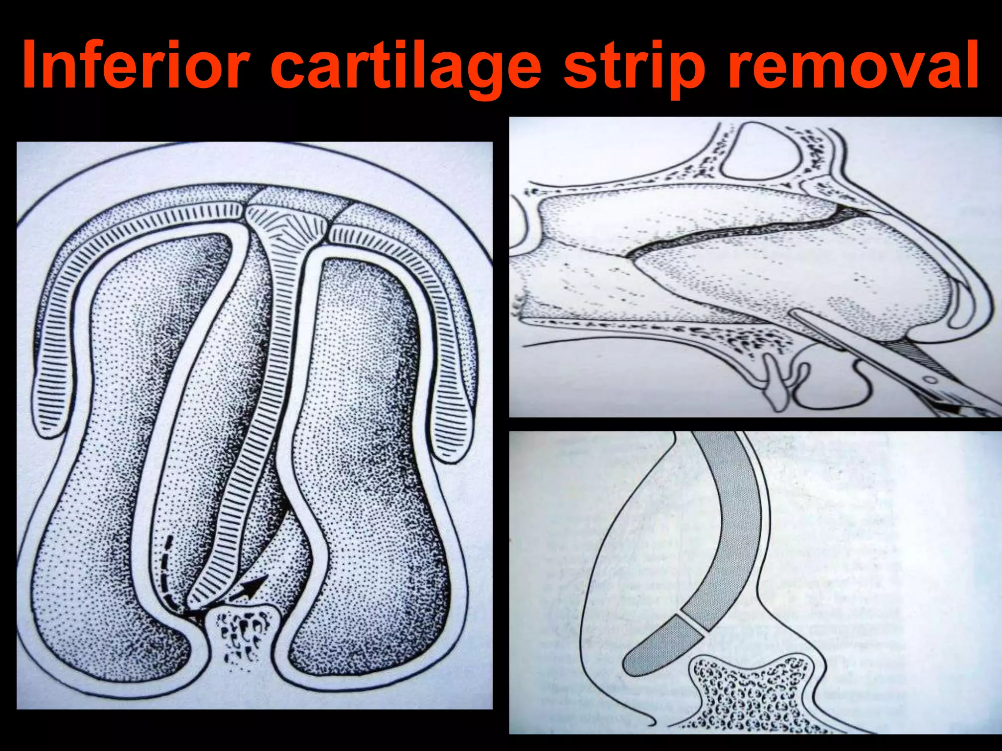 Inferior cartilage strip removal

 