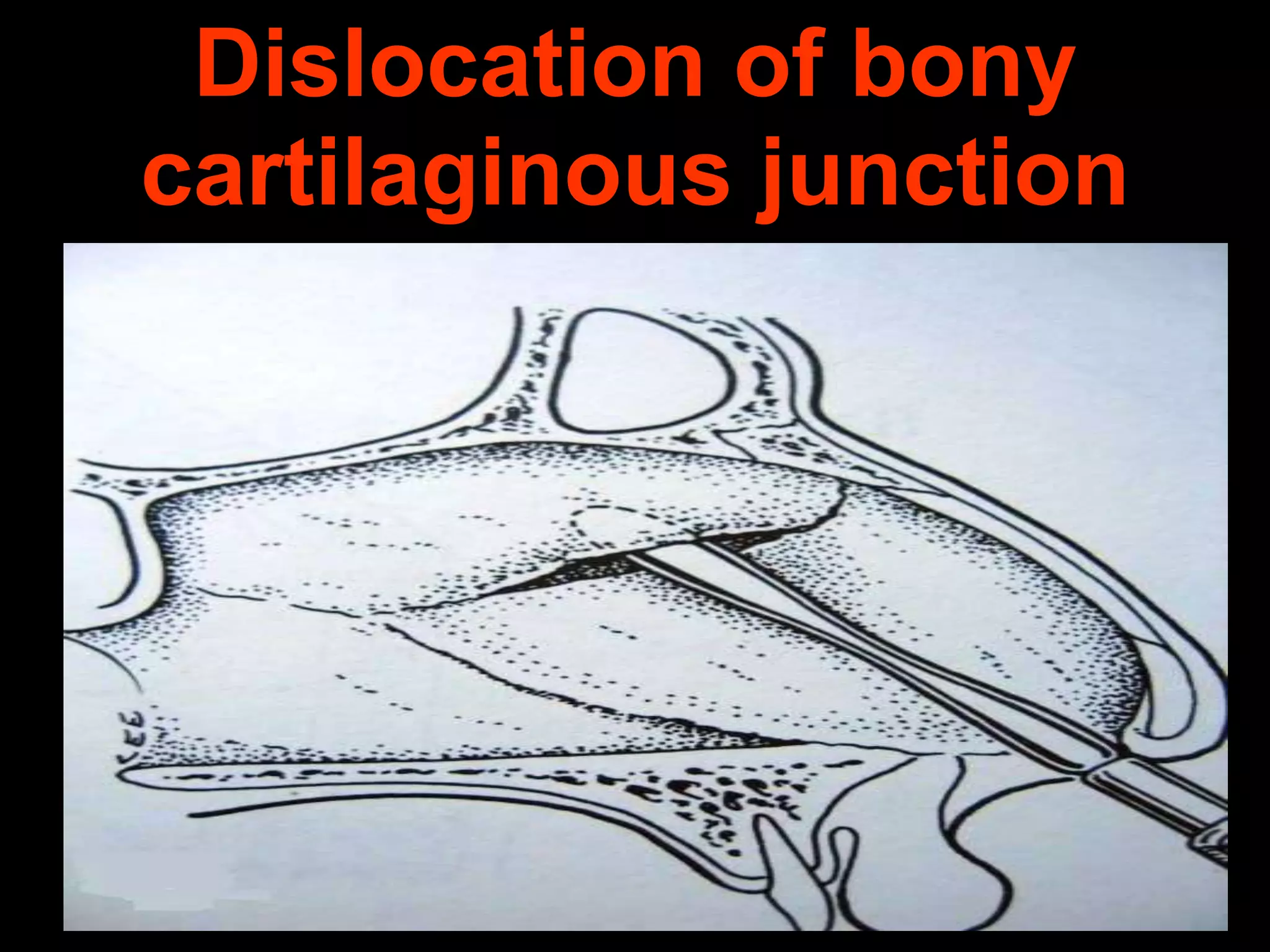 Dislocation of bony
cartilaginous junction

 