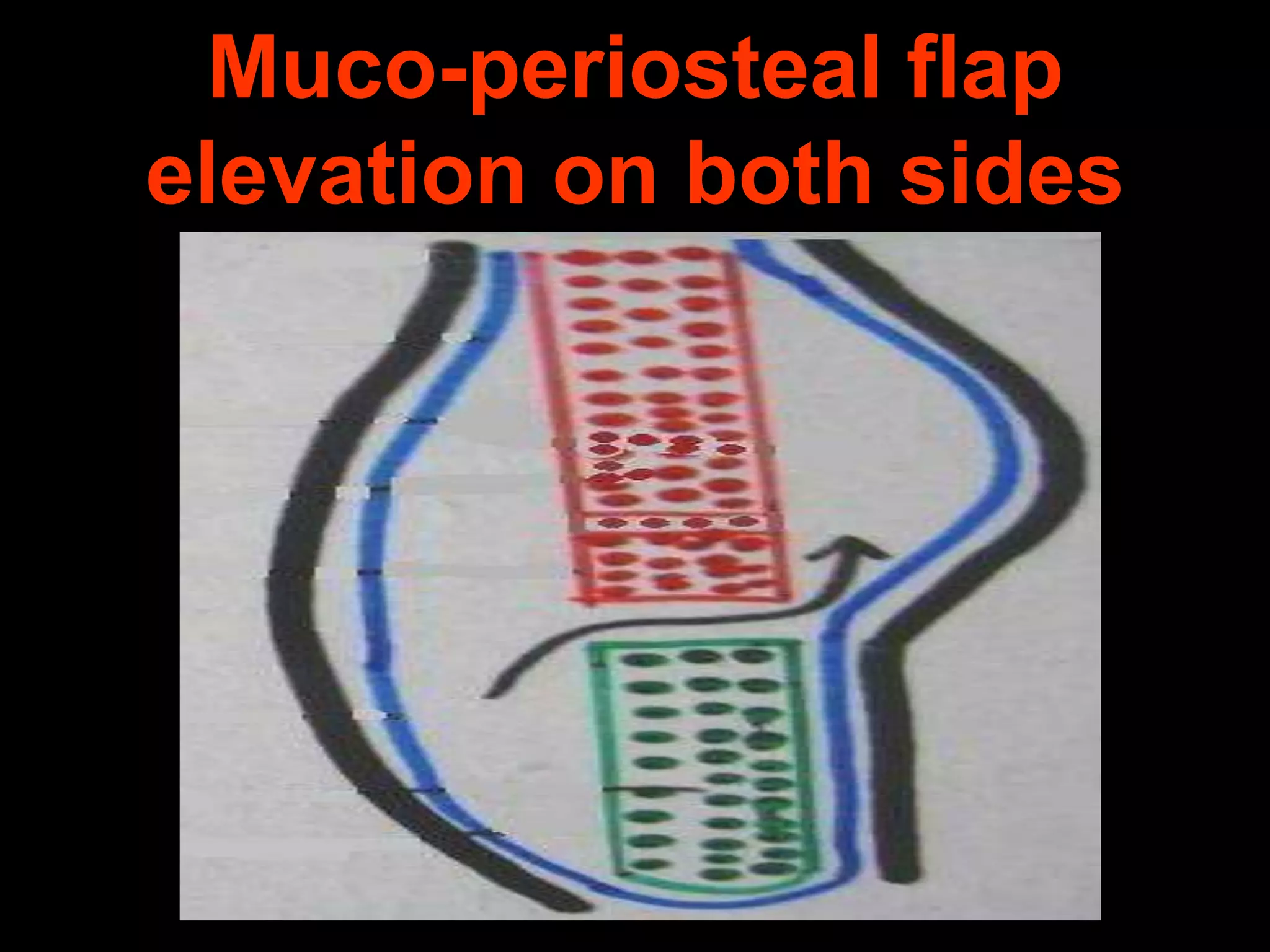 Muco-periosteal flap
elevation on both sides

 