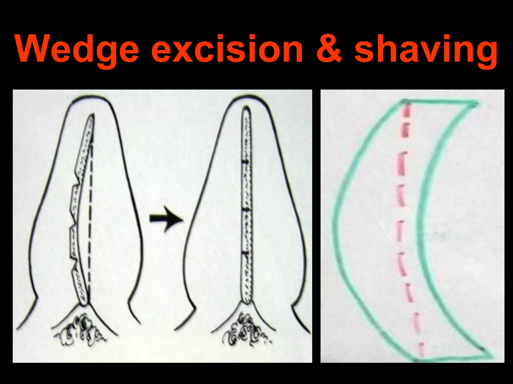 Wedge excision & shaving

 